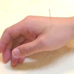 Acupuncture1